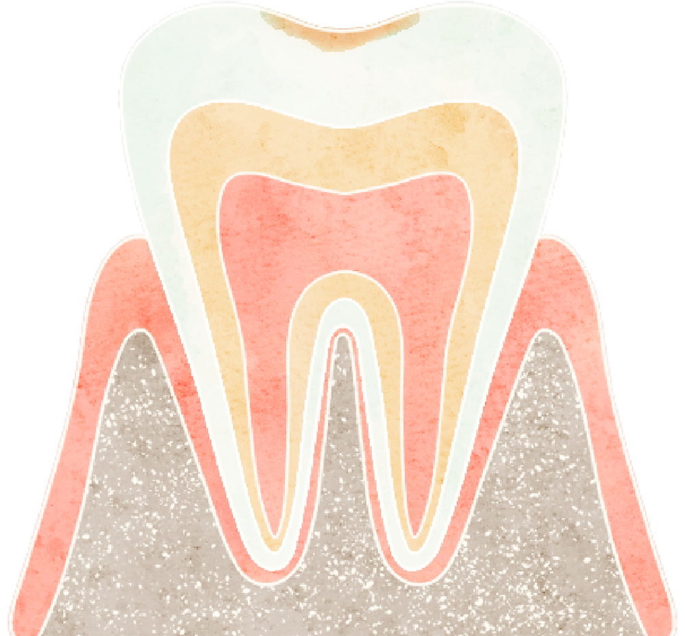 自覚症状のない、定期健診などで見つかる虫歯（初期う蝕、CO~C1）