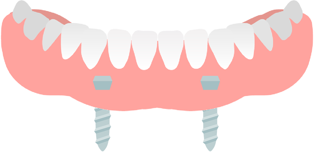 ロケーターアタッチメント義歯